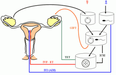 体外受精胚胎移植IVF-ET的主要步骤